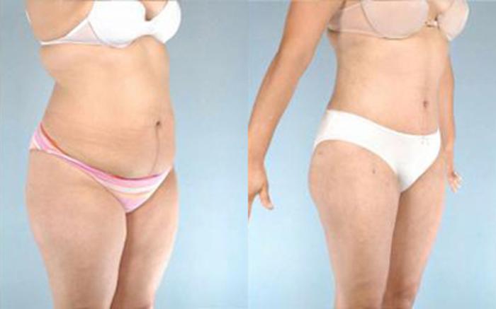 Before & After Tummy Tuck Case 5 View 2 View in Houston, TX