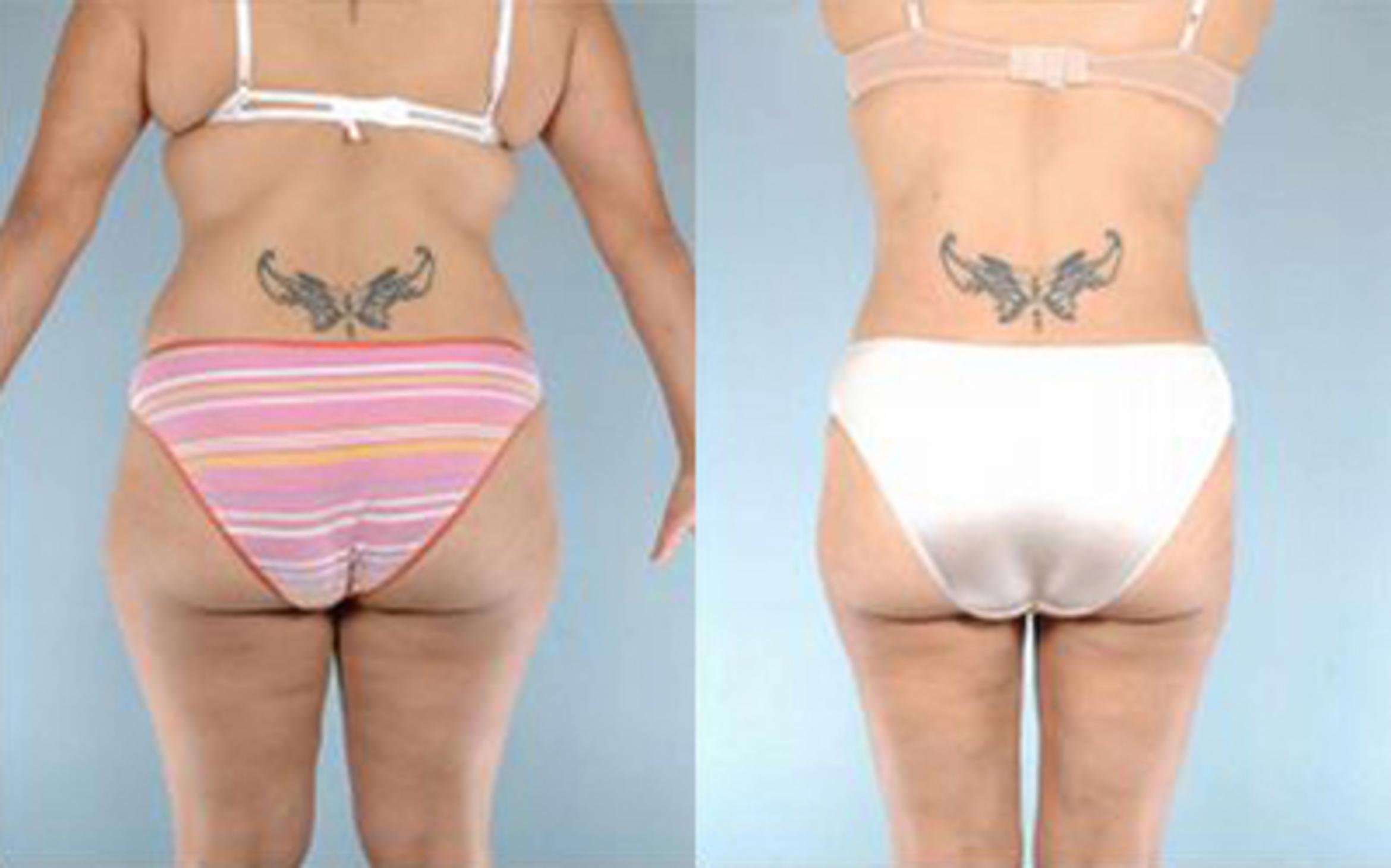 Before & After Tummy Tuck Case 5 View 3 View in Houston, TX