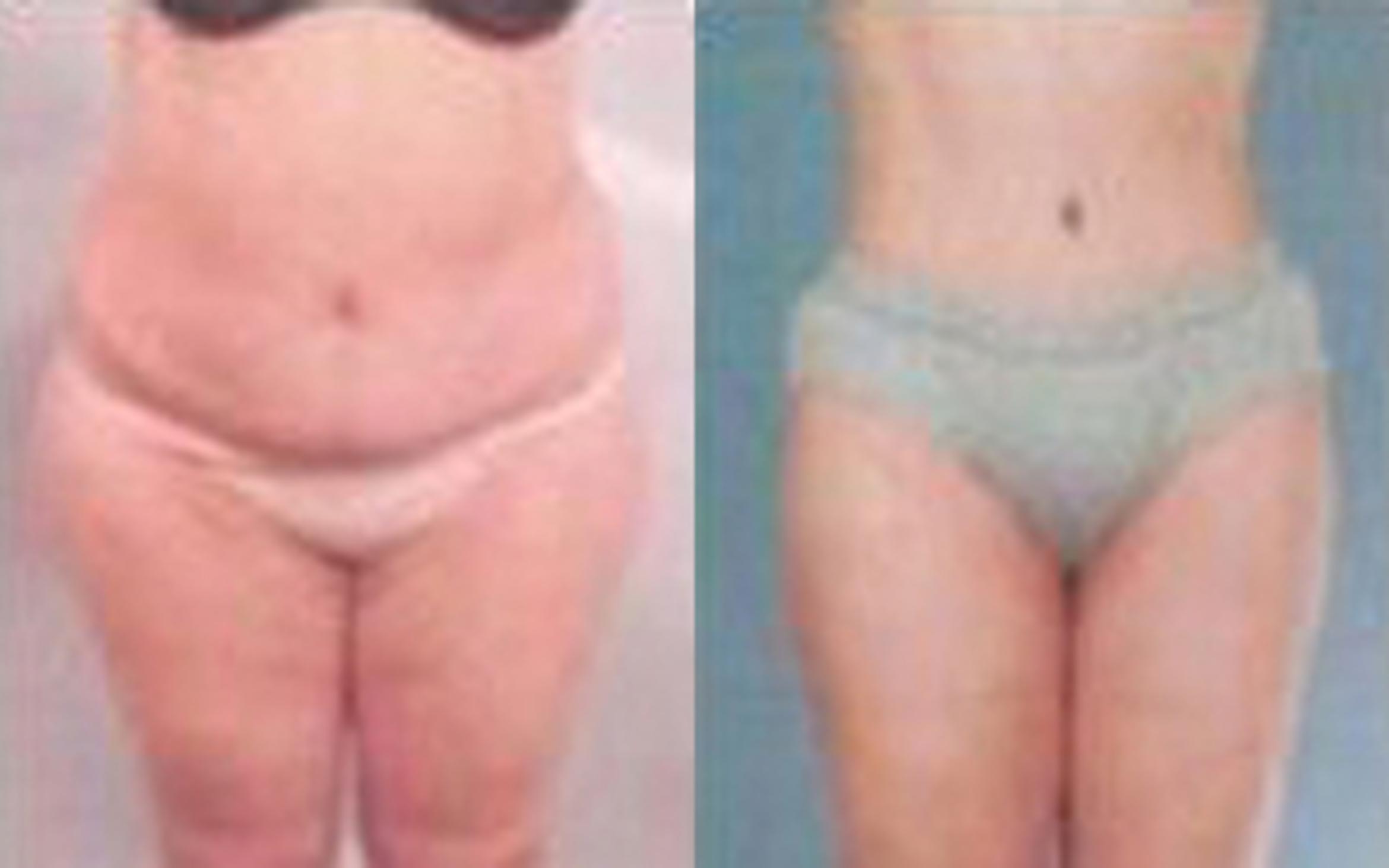 Before & After Tummy Tuck Case 50 View 1 View in Houston, TX