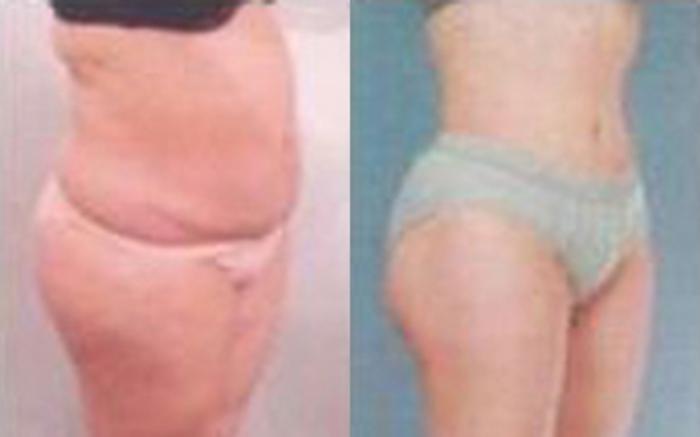 Before & After Tummy Tuck Case 50 View 2 View in Houston, TX