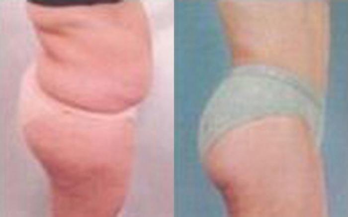 Before & After Tummy Tuck Case 50 View 3 View in Houston, TX