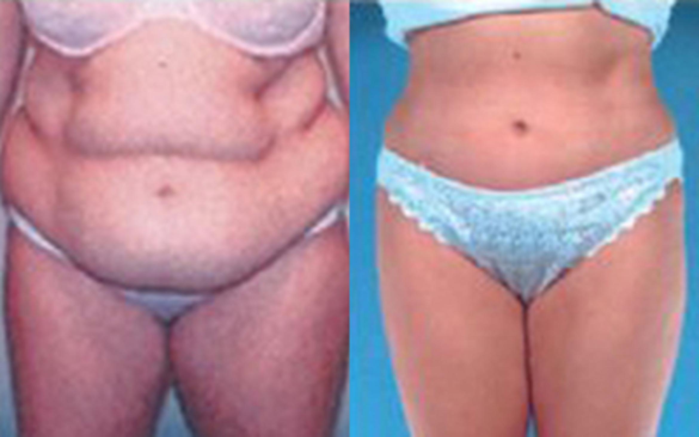 Before & After Tummy Tuck Case 51 View 1 View in Houston, TX