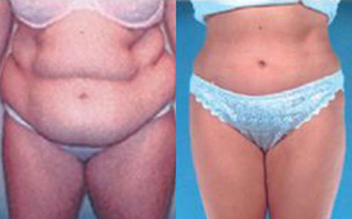 Before & After Tummy Tuck Case 51 View 1 View in Houston, TX
