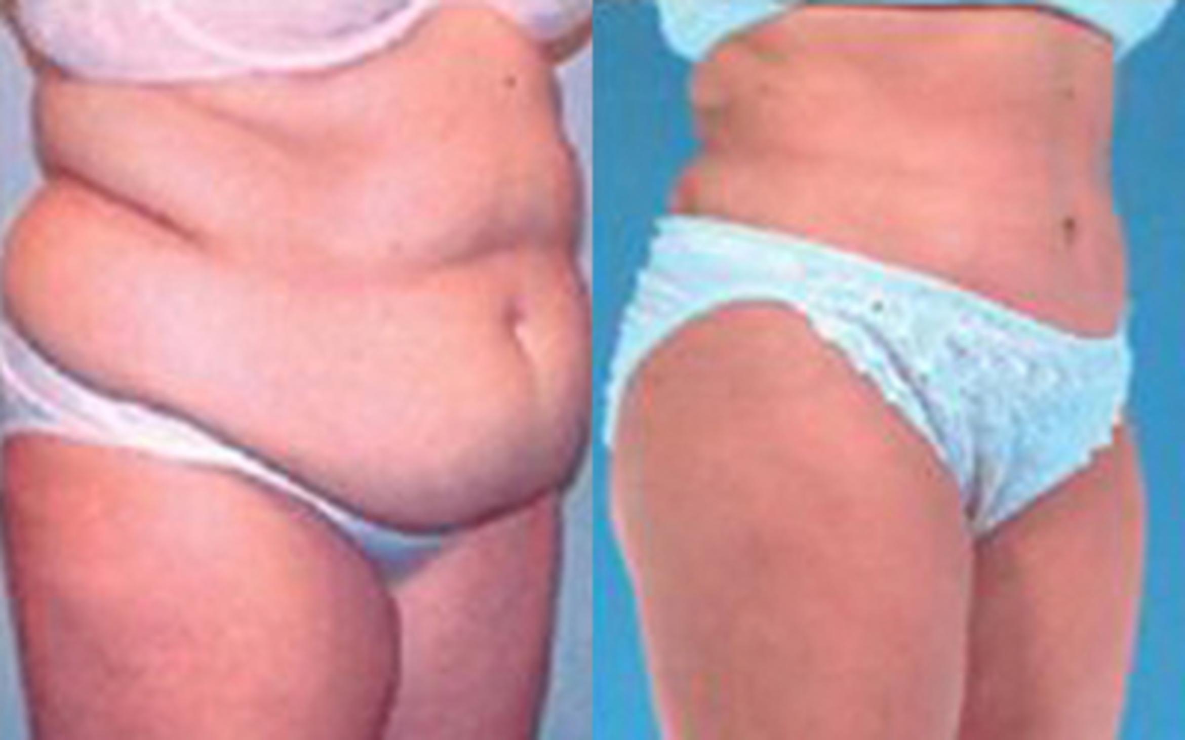 Before & After Tummy Tuck Case 51 View 2 View in Houston, TX
