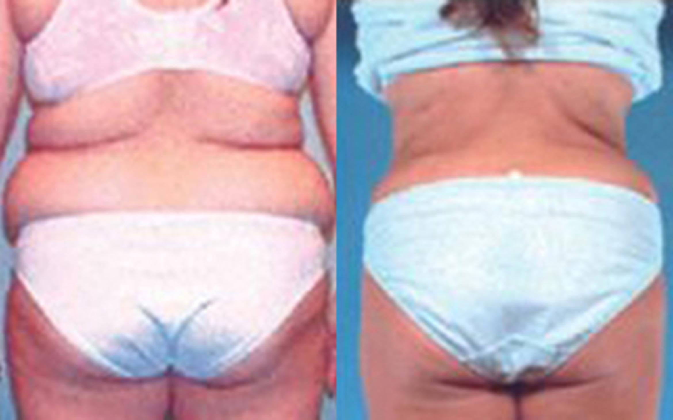 Before & After Tummy Tuck Case 51 View 3 View in Houston, TX