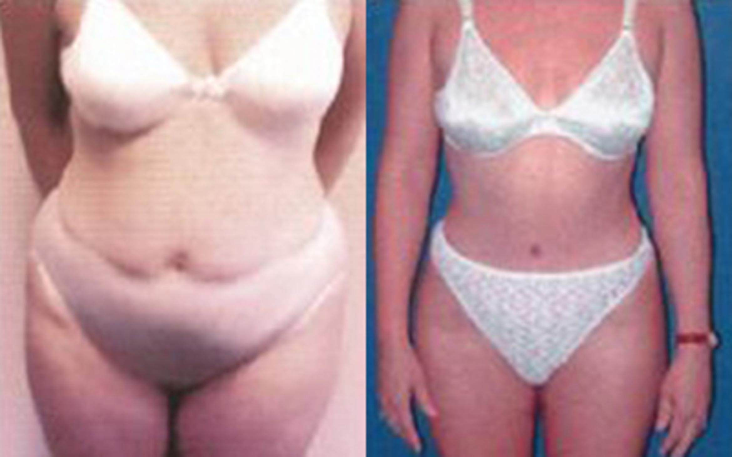 Before & After Tummy Tuck Case 52 View 1 View in Houston, TX