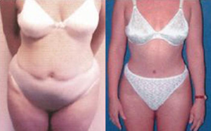 Before & After Tummy Tuck Case 52 View 1 View in Houston, TX