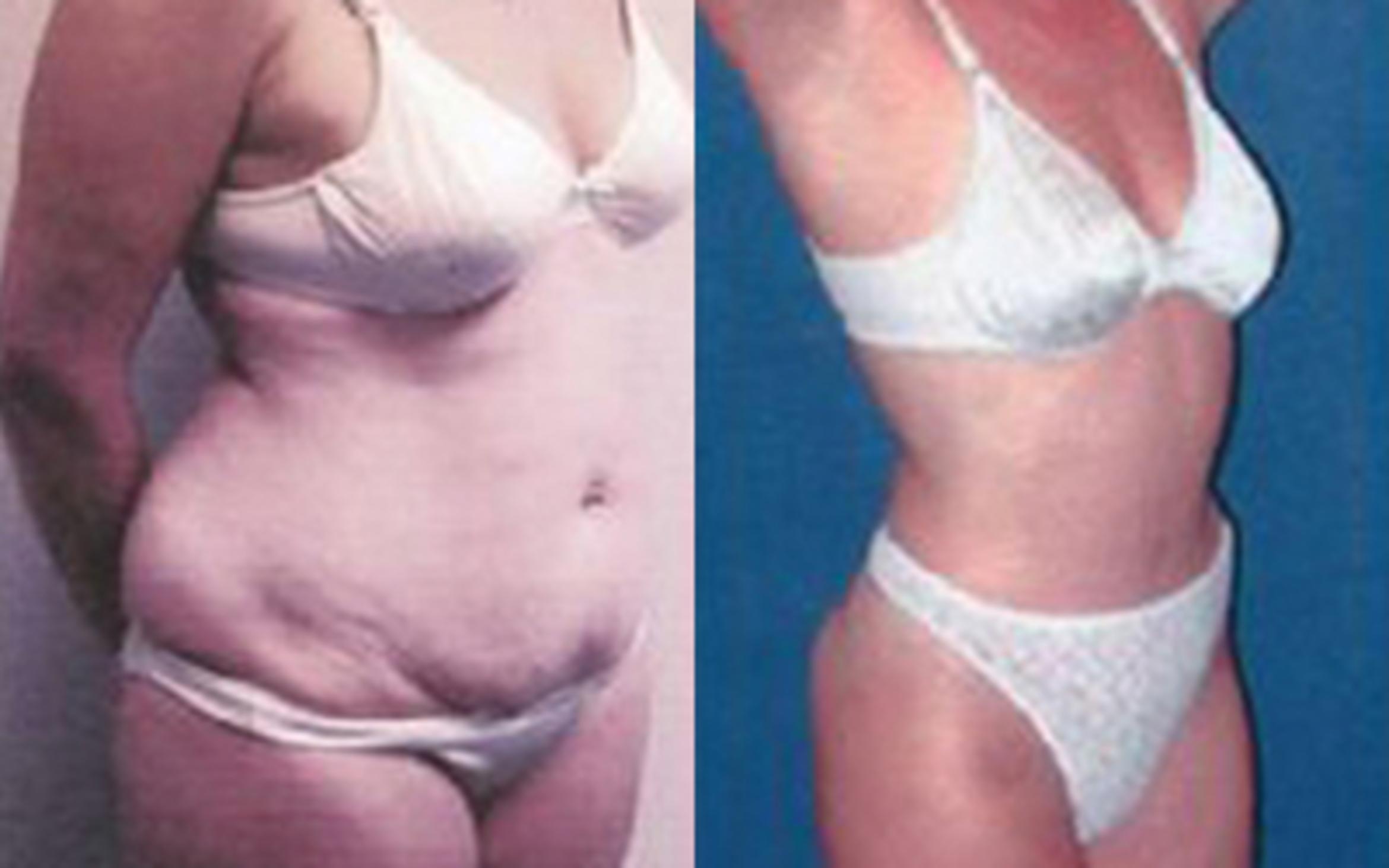 Before & After Tummy Tuck Case 52 View 2 View in Houston, TX