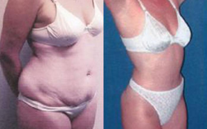 Before & After Tummy Tuck Case 52 View 2 View in Houston, TX