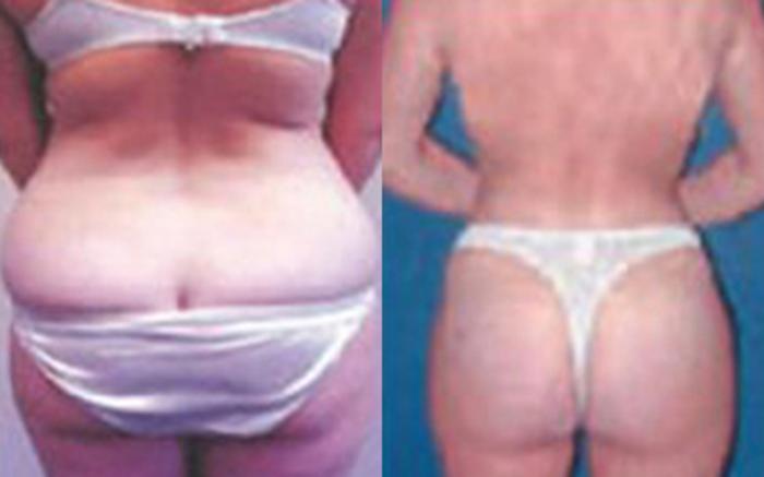 Before & After Tummy Tuck Case 52 View 3 View in Houston, TX
