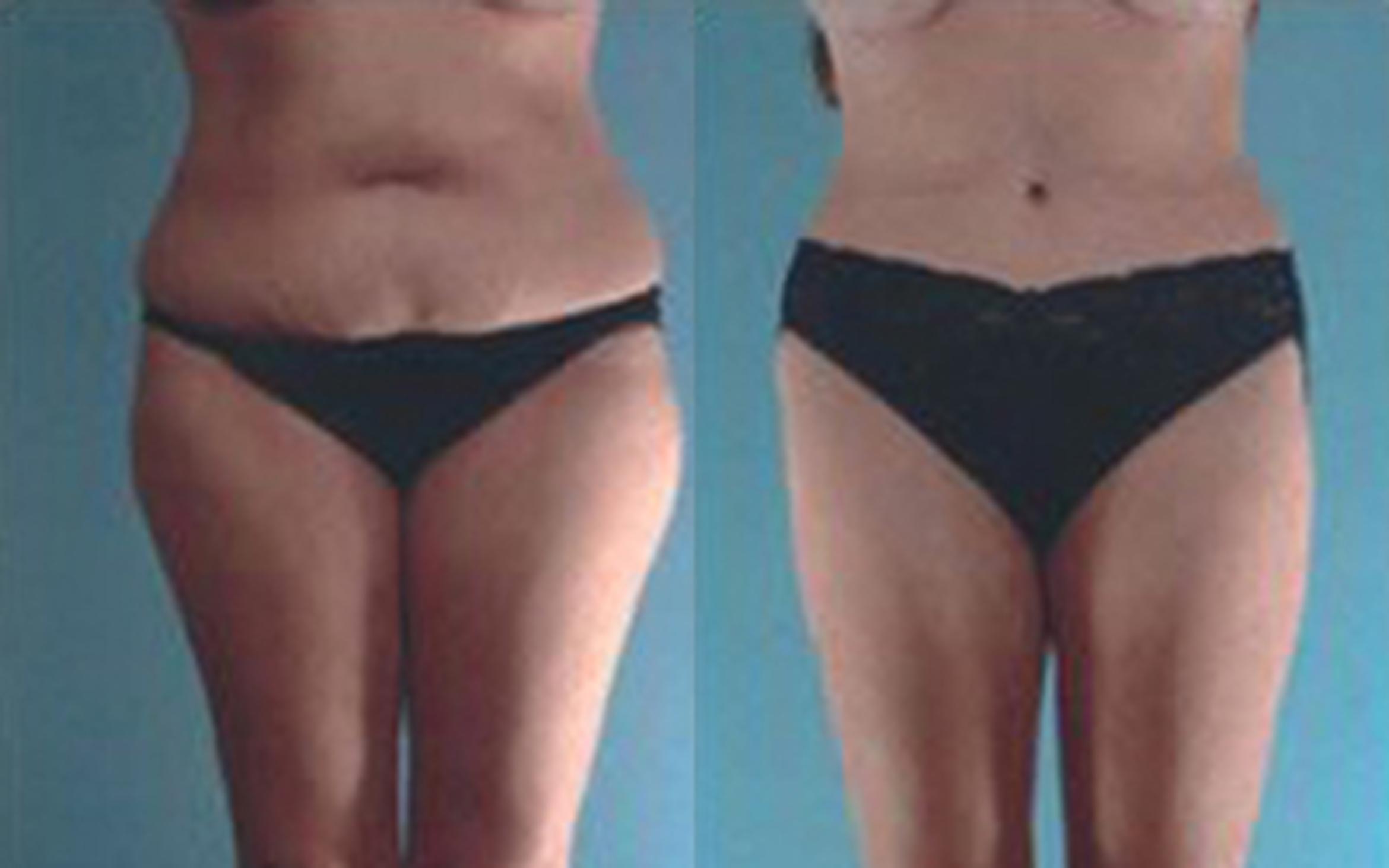 Before & After Tummy Tuck Case 53 View 1 View in Houston, TX