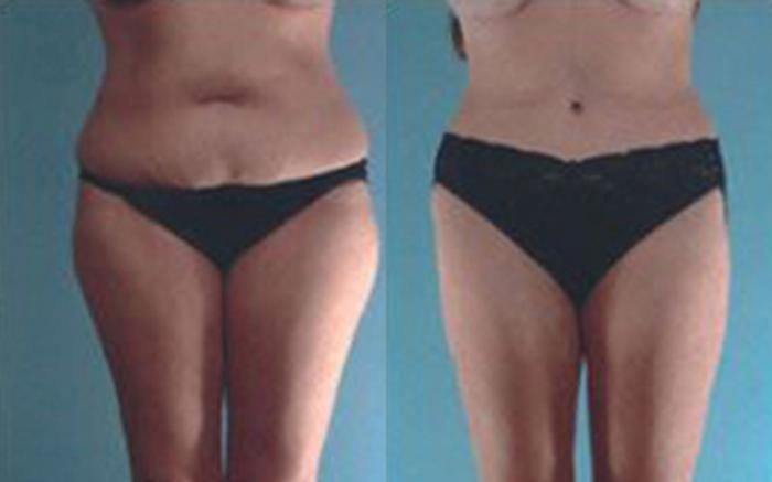 Before & After Tummy Tuck Case 53 View 1 View in Houston, TX