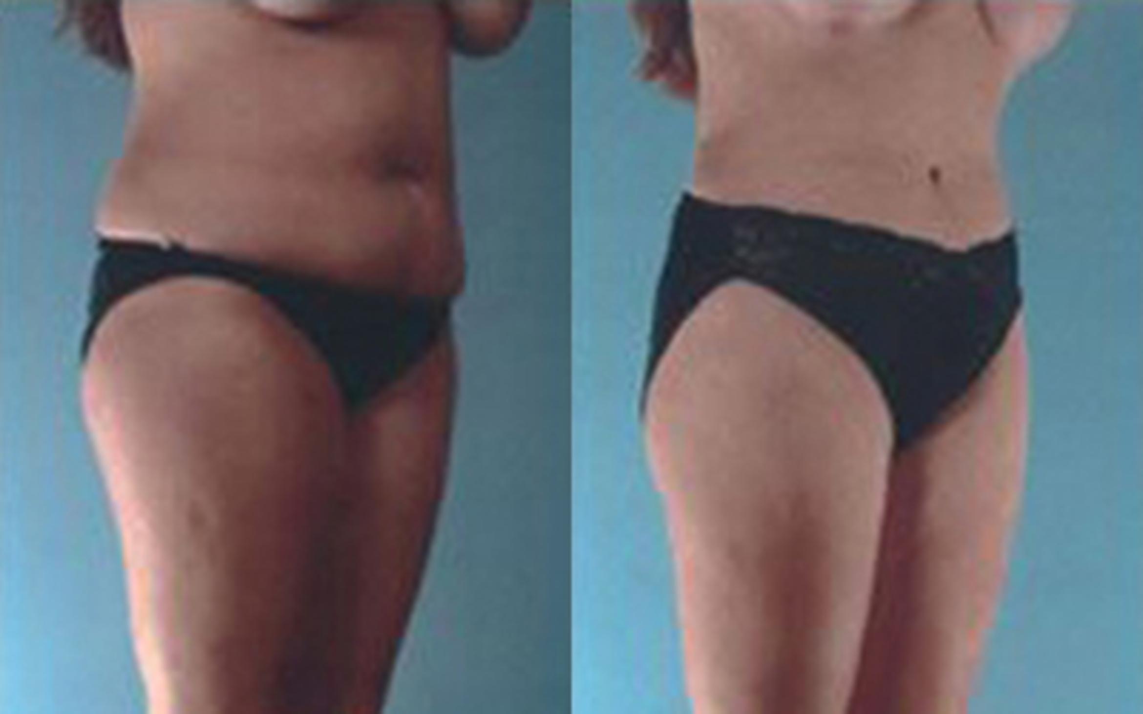 Before & After Tummy Tuck Case 53 View 2 View in Houston, TX