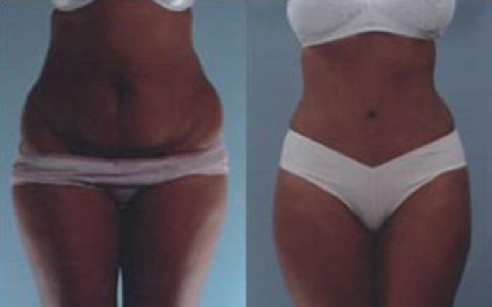 Before & After Tummy Tuck Case 54 View 1 View in Houston, TX
