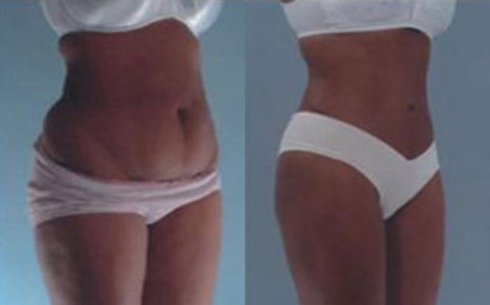 Before & After Tummy Tuck Case 54 View 2 View in Houston, TX
