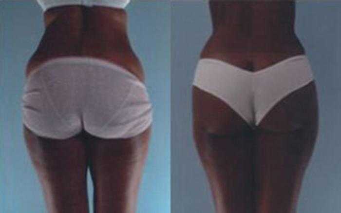 Before & After Tummy Tuck Case 54 View 3 View in Houston, TX