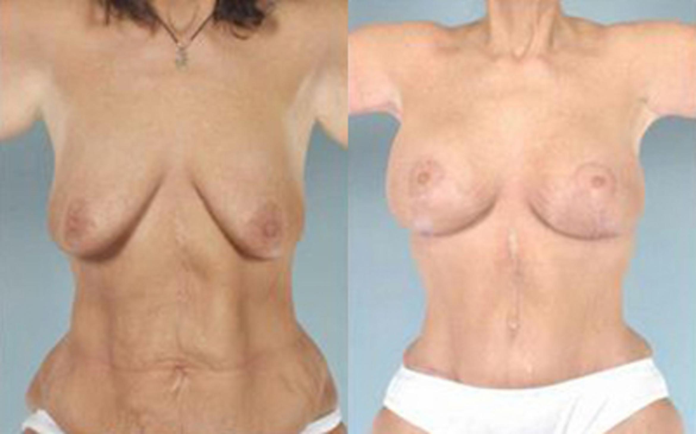 Before & After Tummy Tuck Case 55 View 1 View in Houston, TX