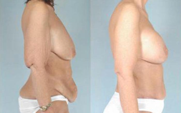 Before & After Tummy Tuck Case 55 View 3 View in Houston, TX