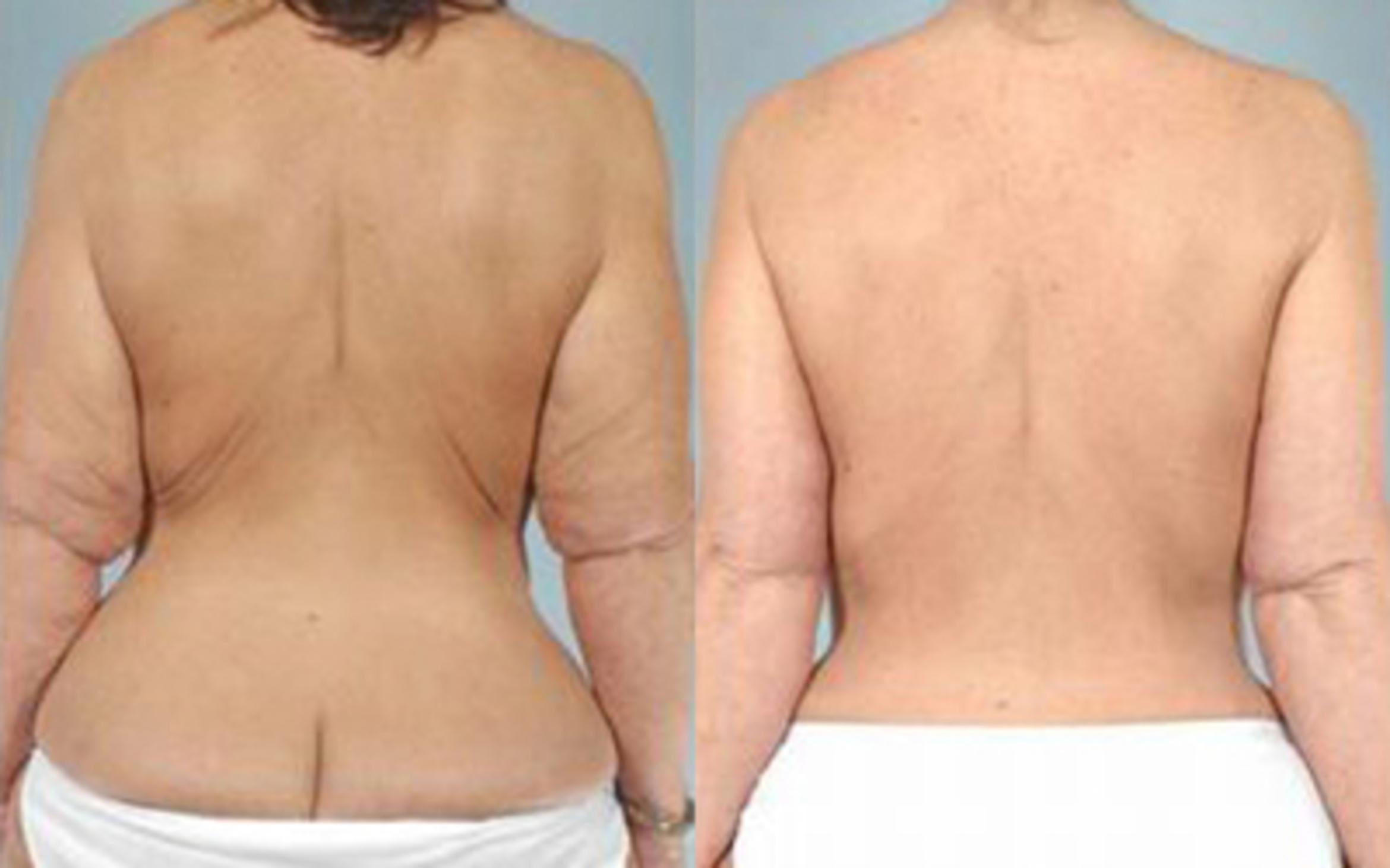 Before & After Tummy Tuck Case 55 View 4 View in Houston, TX