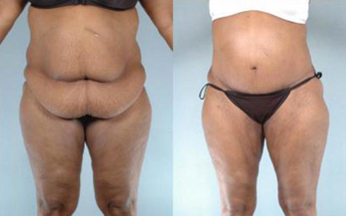 Before & After Tummy Tuck Case 56 View 1 View in Houston, TX