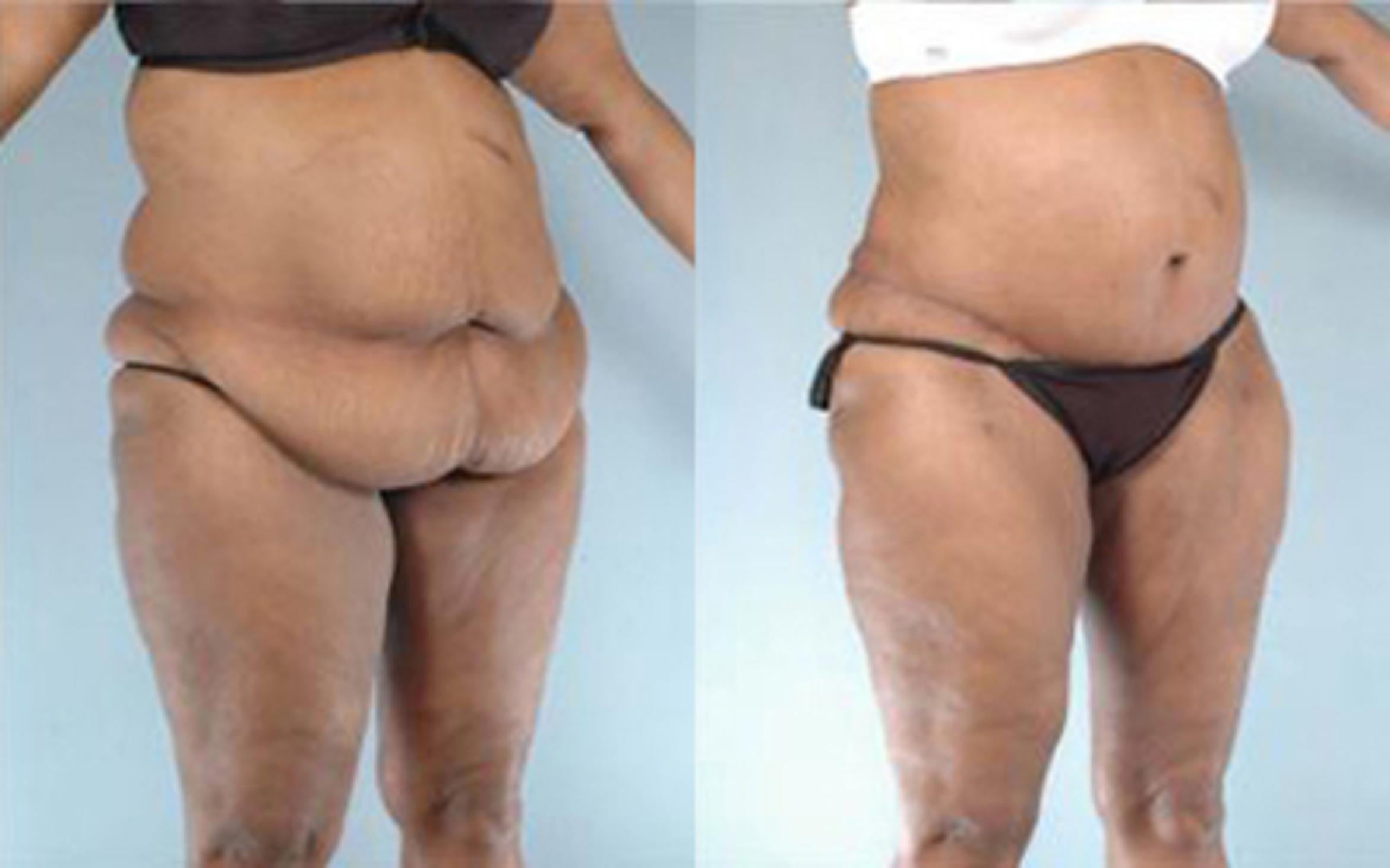 Before & After Tummy Tuck Case 56 View 2 View in Houston, TX