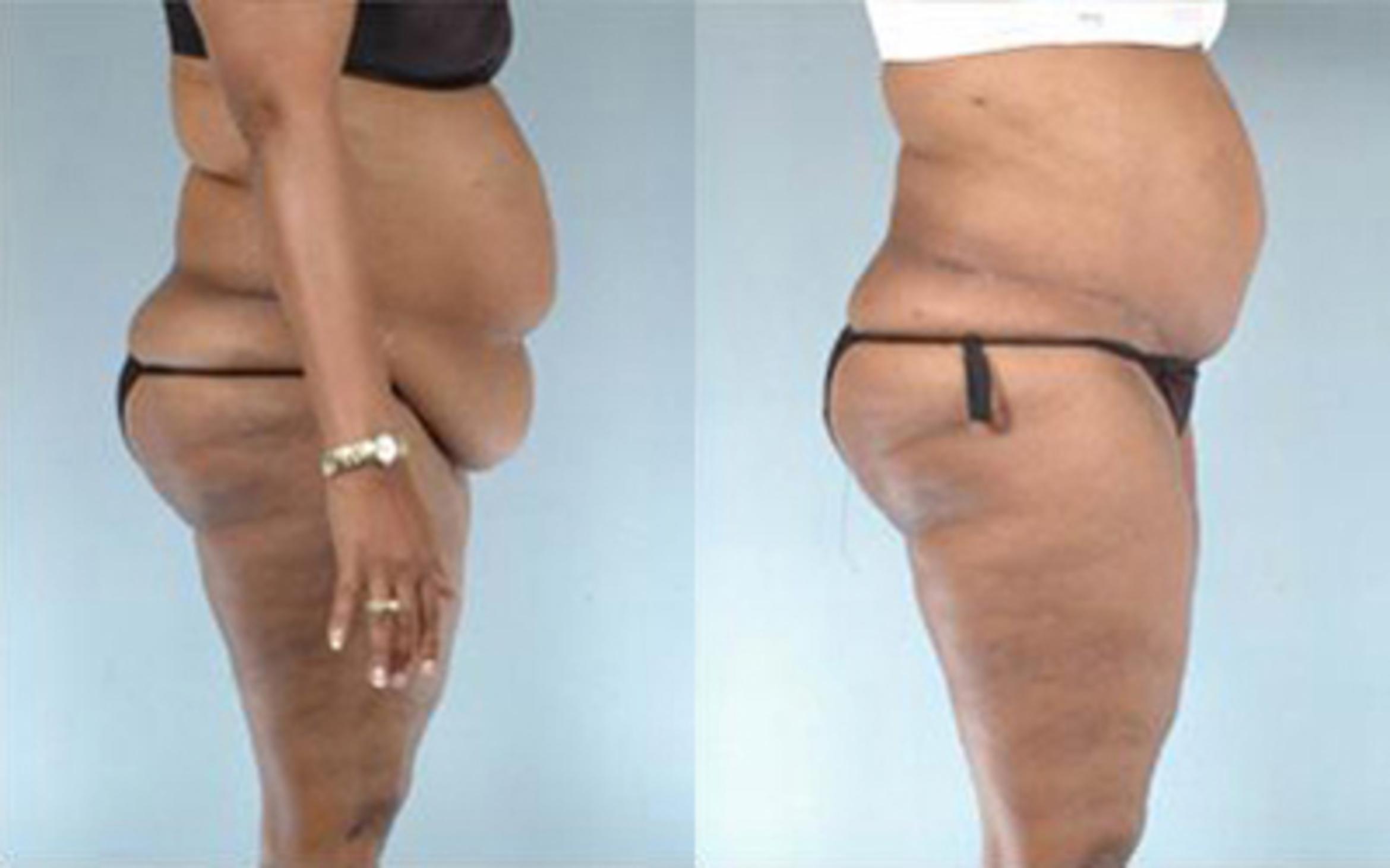 Before & After Tummy Tuck Case 56 View 3 View in Houston, TX