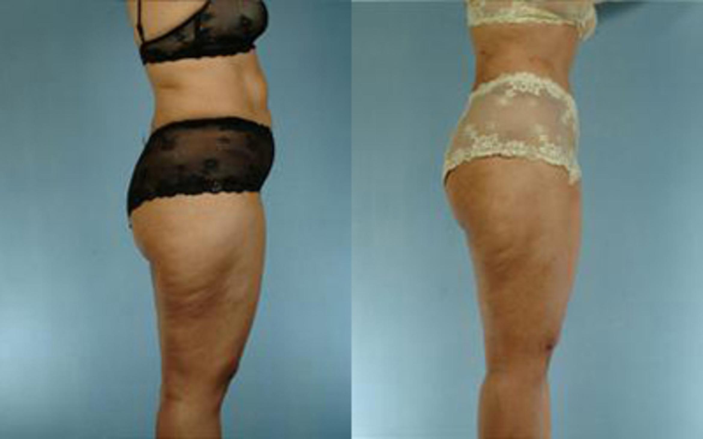 Before & After Tummy Tuck Case 57 View 2 View in Houston, TX