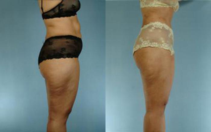Before & After Tummy Tuck Case 57 View 2 View in Houston, TX
