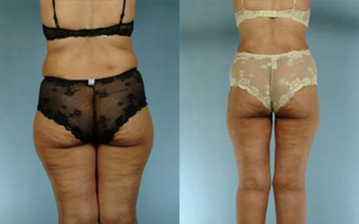 Before & After Tummy Tuck Case 57 View 3 View in Houston, TX