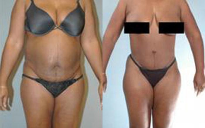 Before & After Tummy Tuck Case 58 View 1 View in Houston, TX