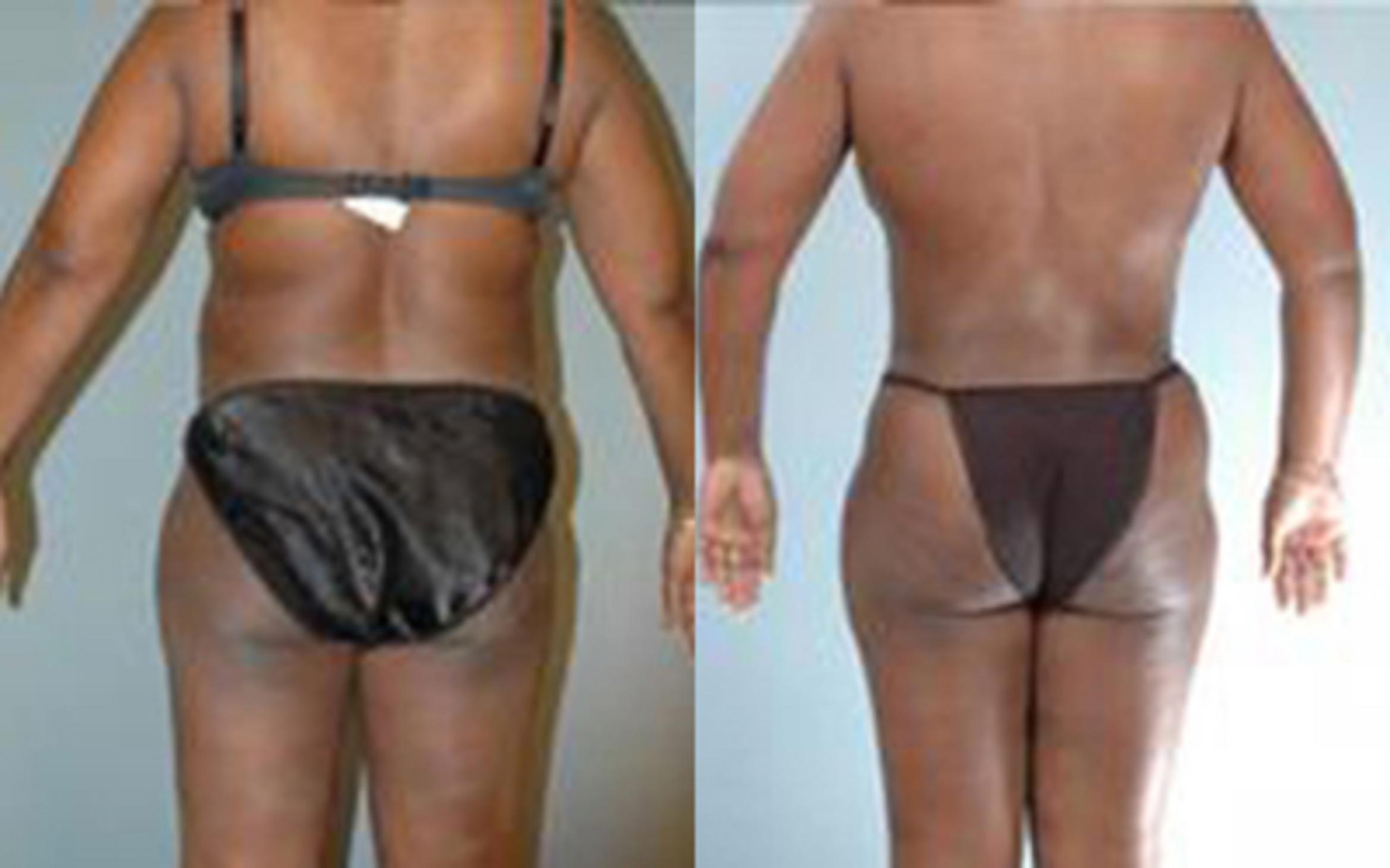 Before & After Tummy Tuck Case 58 View 4 View in Houston, TX