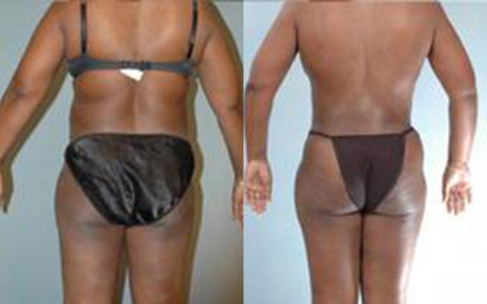Before & After Tummy Tuck Case 58 View 4 View in Houston, TX