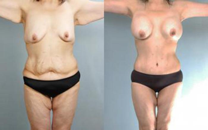 Before & After Tummy Tuck Case 59 View 1 View in Houston, TX