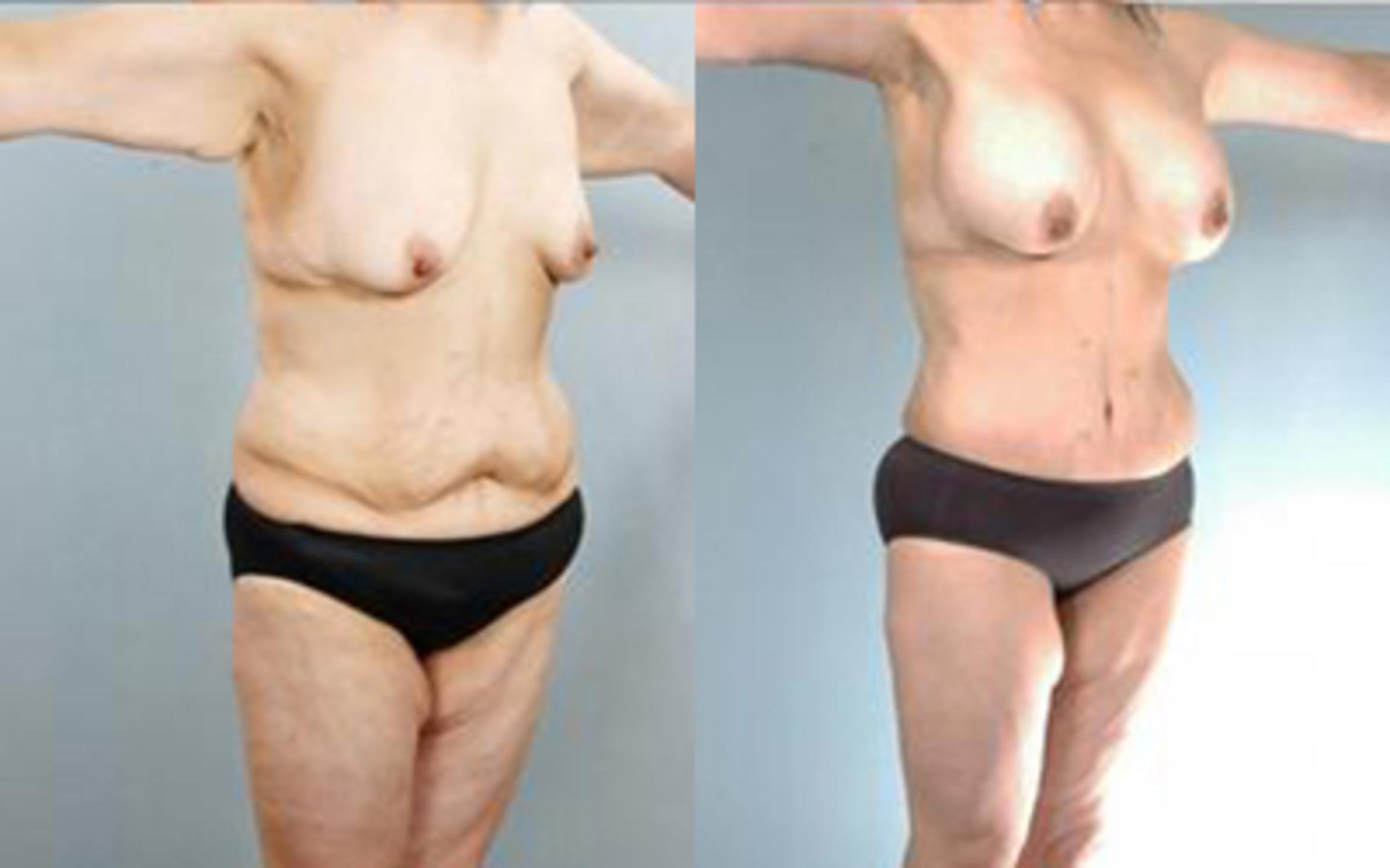 Before & After Tummy Tuck Case 59 View 2 View in Houston, TX