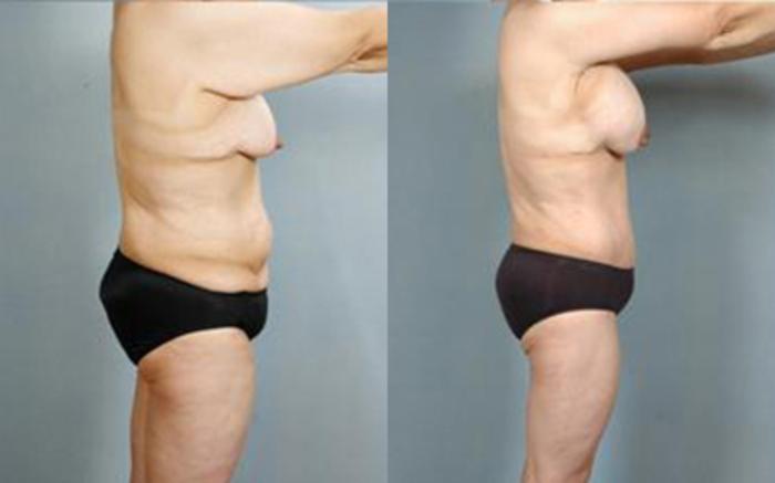 Before & After Tummy Tuck Case 59 View 3 View in Houston, TX