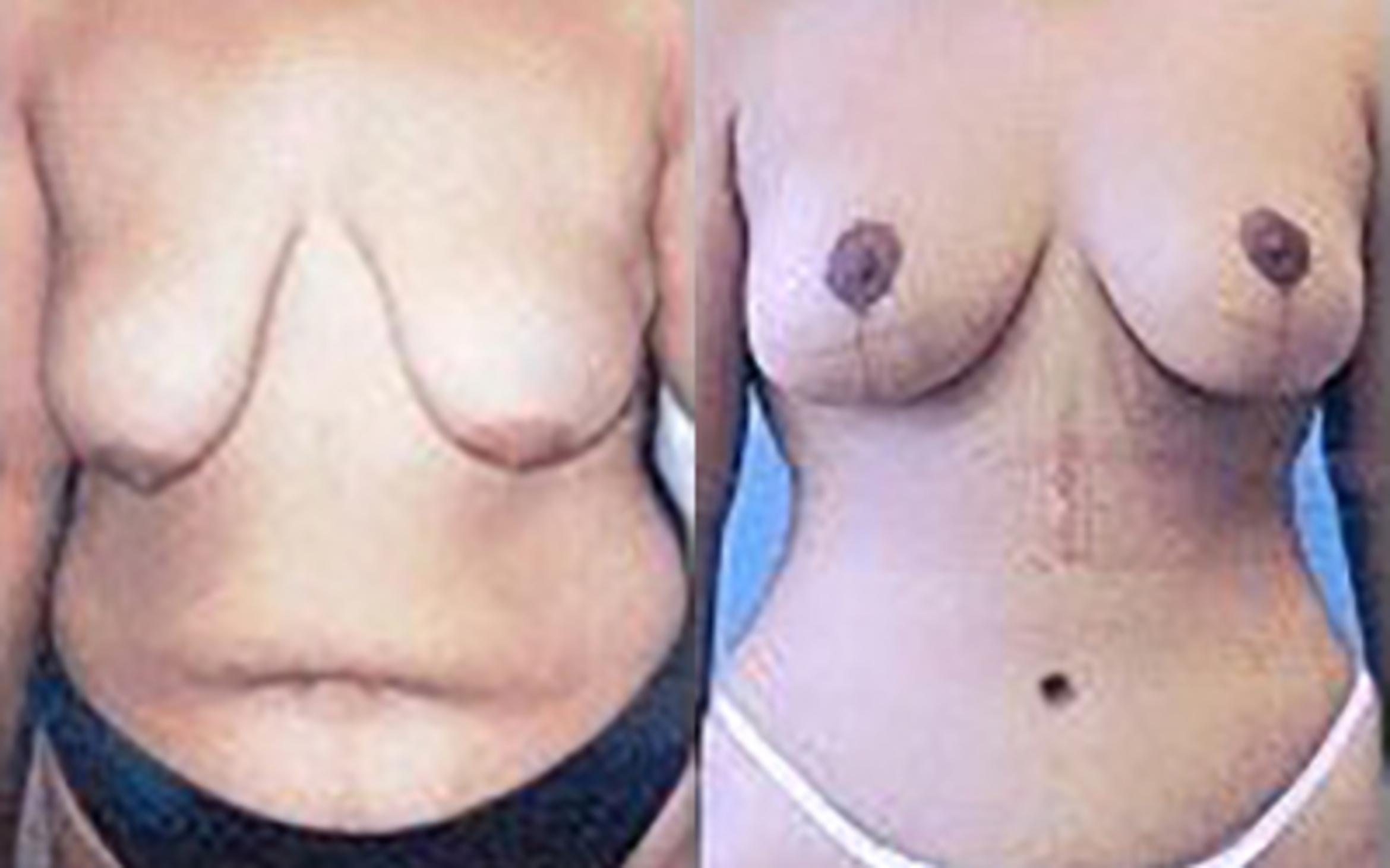 Before & After Tummy Tuck Case 5944 View 1 View in Houston, TX