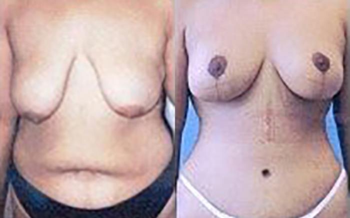 Before & After Tummy Tuck Case 5944 View 1 View in Houston, TX