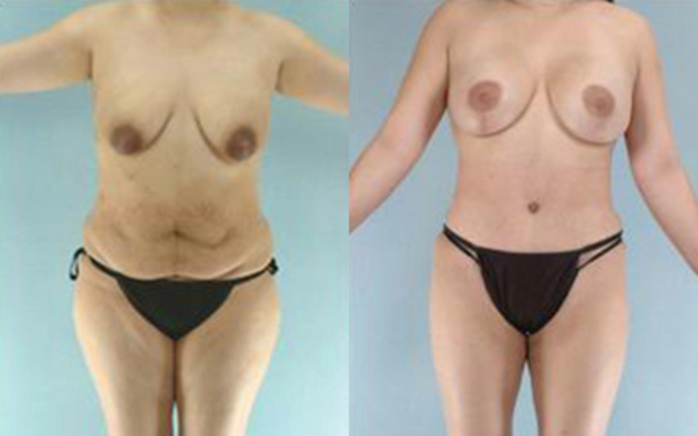 Before & After Tummy Tuck Case 6 View 1 View in Houston, TX