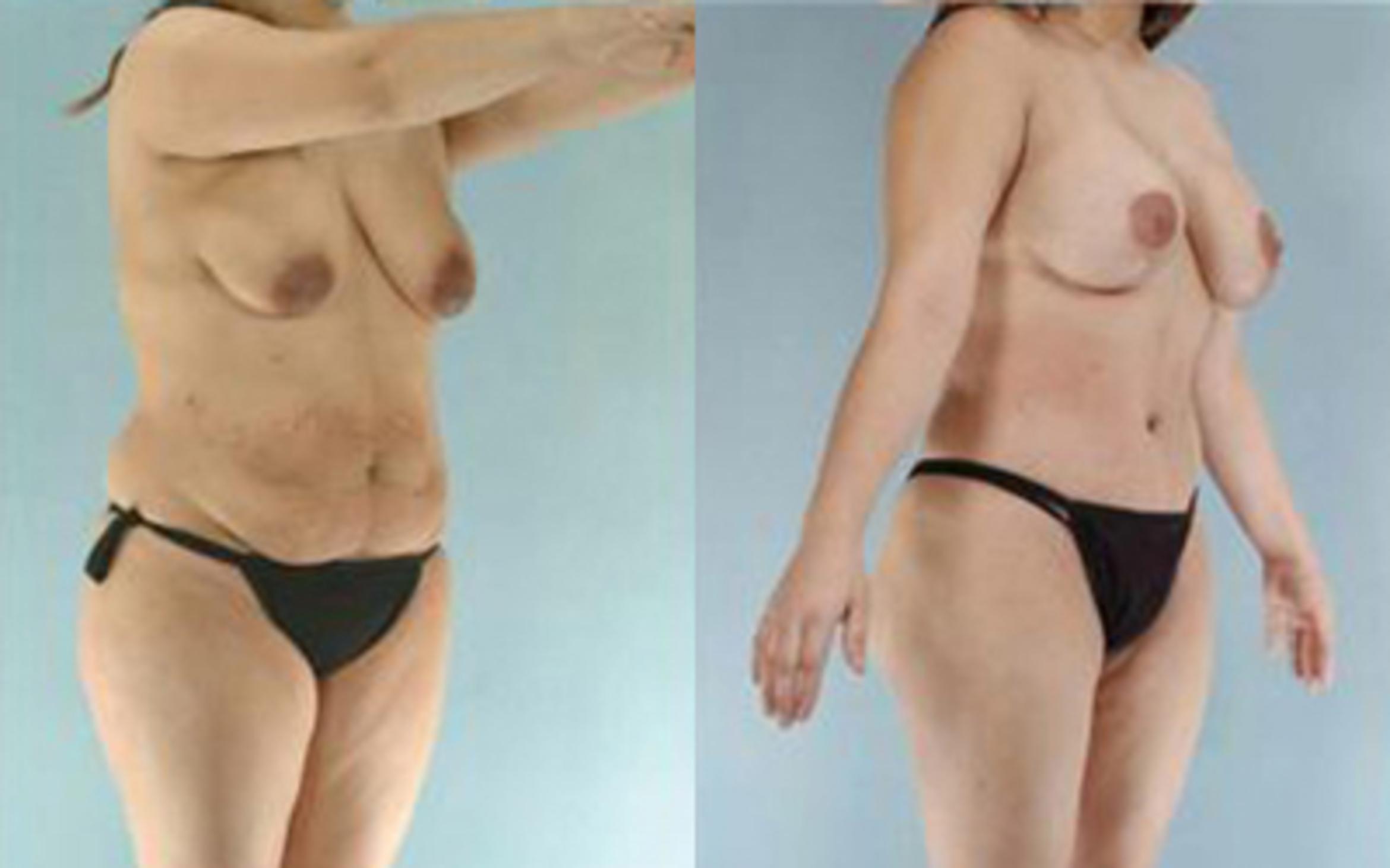 Before & After Tummy Tuck Case 6 View 2 View in Houston, TX