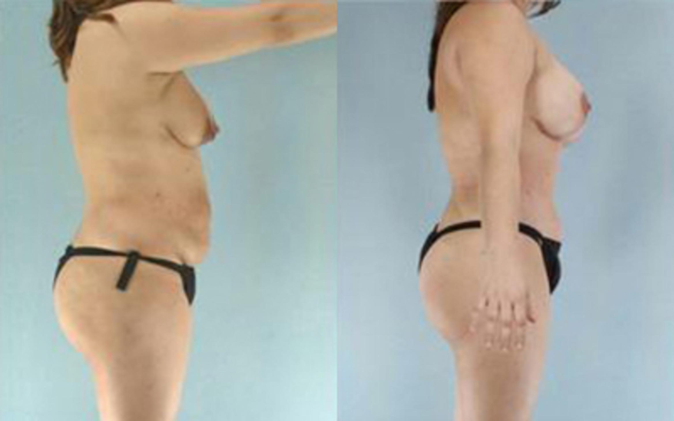 Before & After Tummy Tuck Case 6 View 3 View in Houston, TX