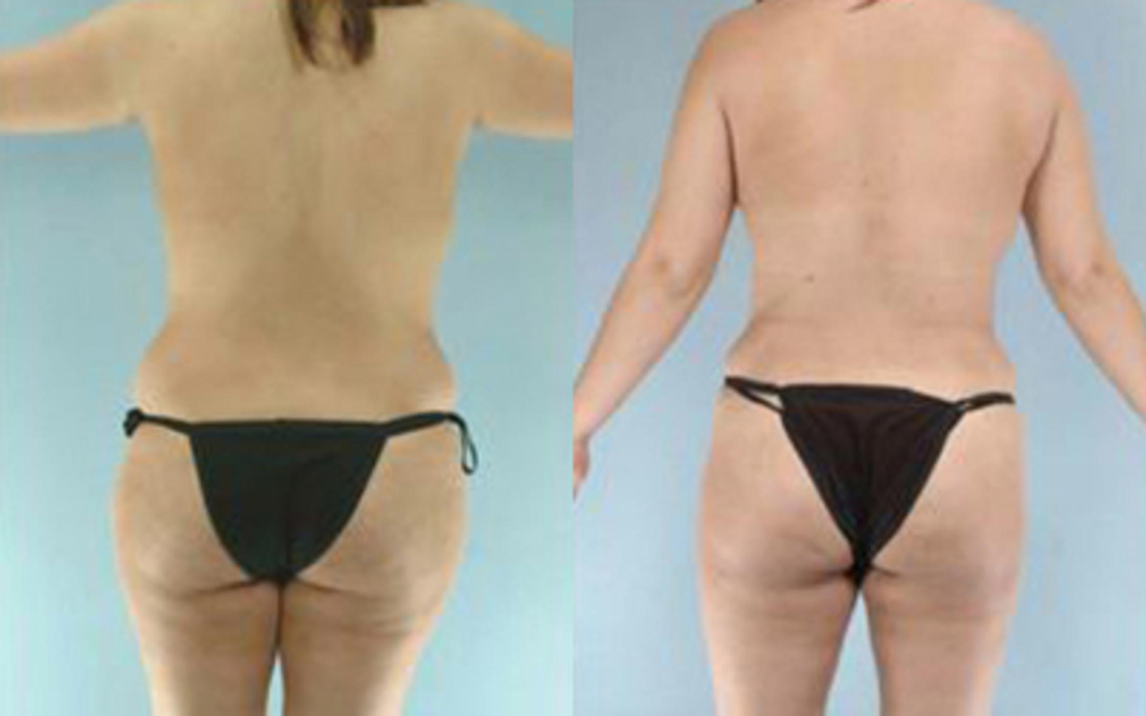 Before & After Tummy Tuck Case 6 View 4 View in Houston, TX