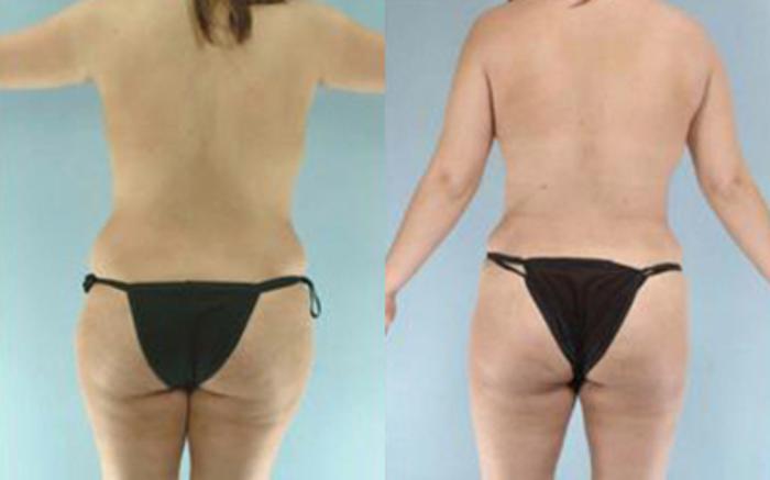 Before & After Tummy Tuck Case 6 View 4 View in Houston, TX