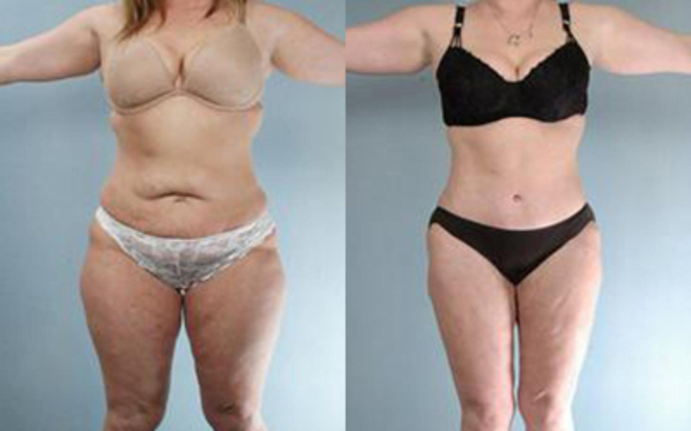 Before & After Tummy Tuck Case 60 View 1 View in Houston, TX