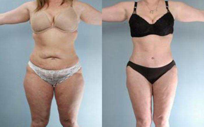 Before & After Tummy Tuck Case 60 View 1 View in Houston, TX