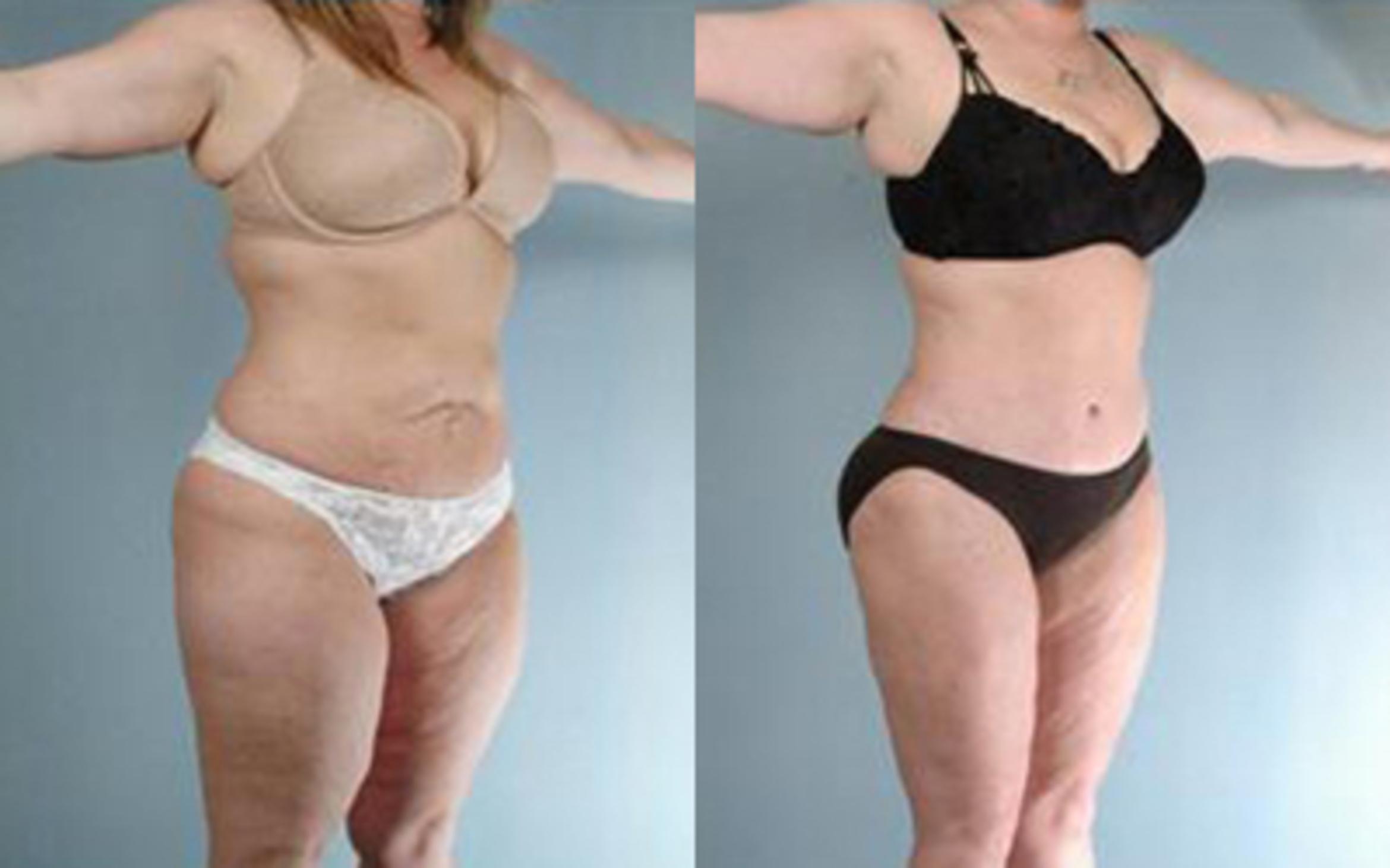 Before & After Tummy Tuck Case 60 View 2 View in Houston, TX
