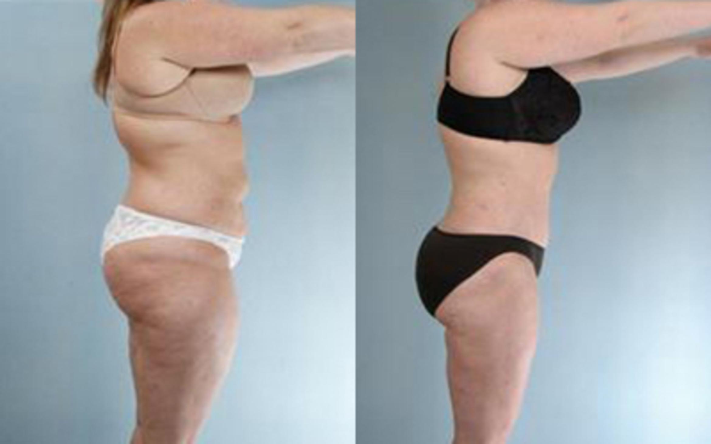 Before & After Tummy Tuck Case 60 View 3 View in Houston, TX