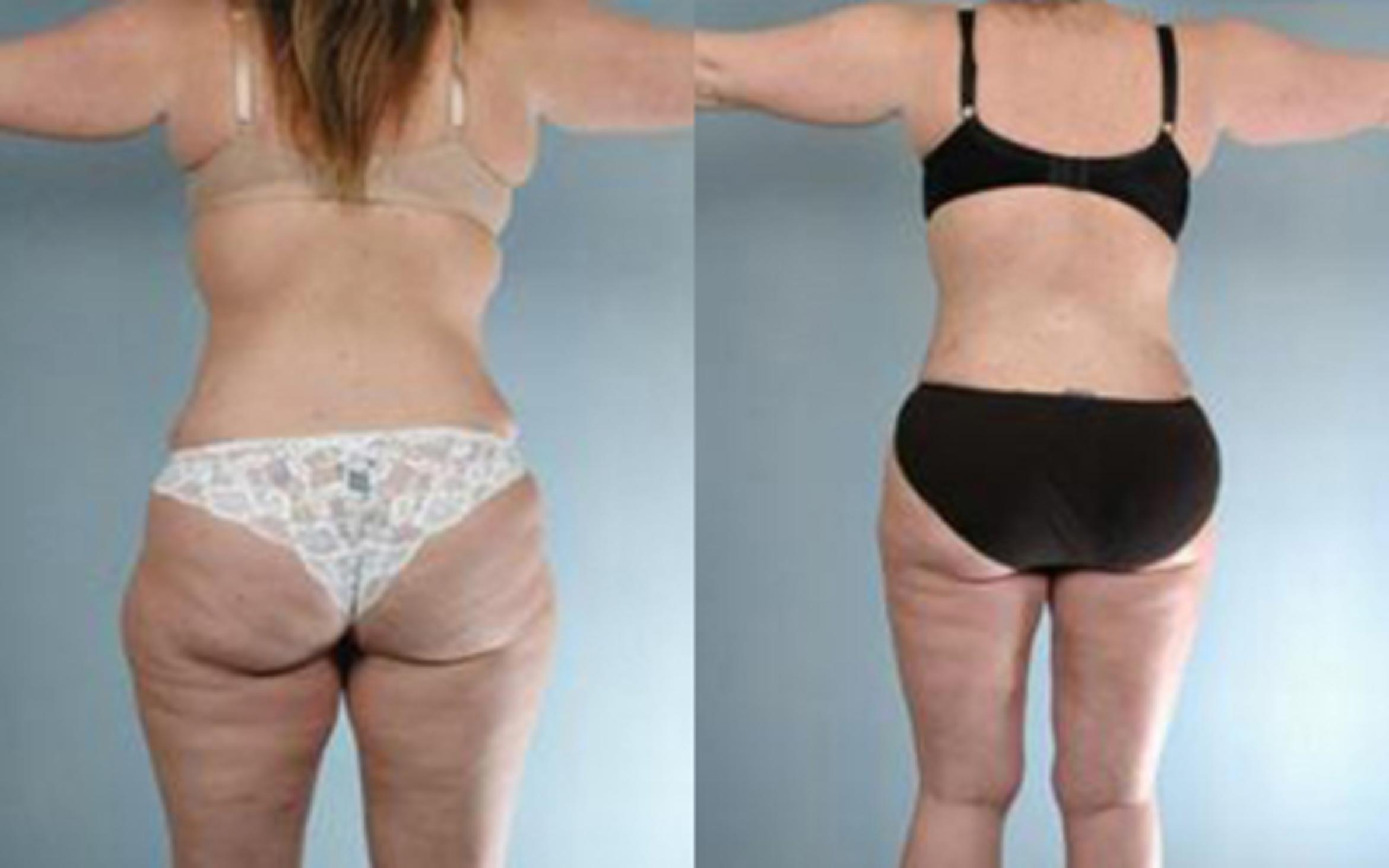 Before & After Tummy Tuck Case 60 View 4 View in Houston, TX