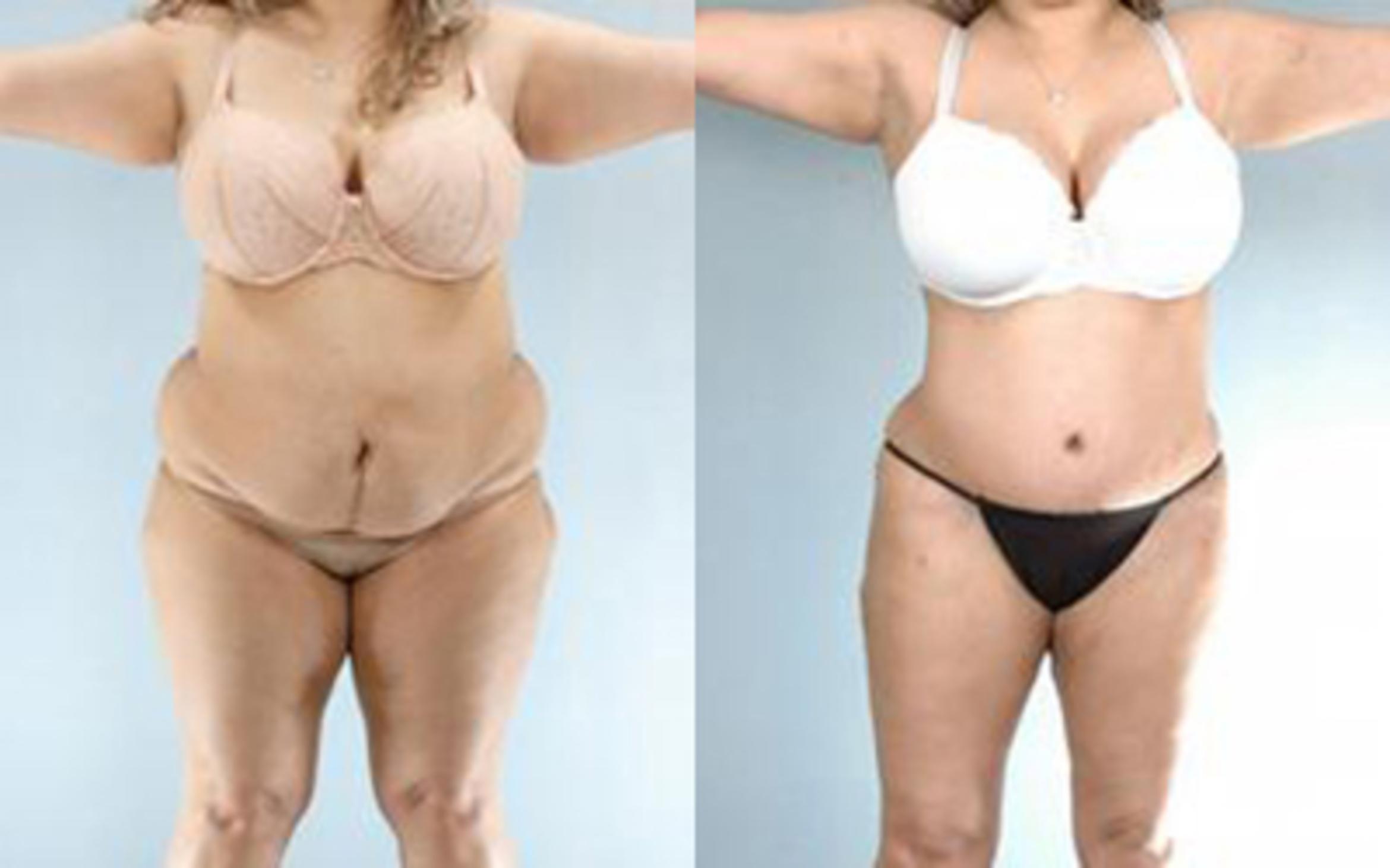 Before & After Tummy Tuck Case 61 View 1 View in Houston, TX