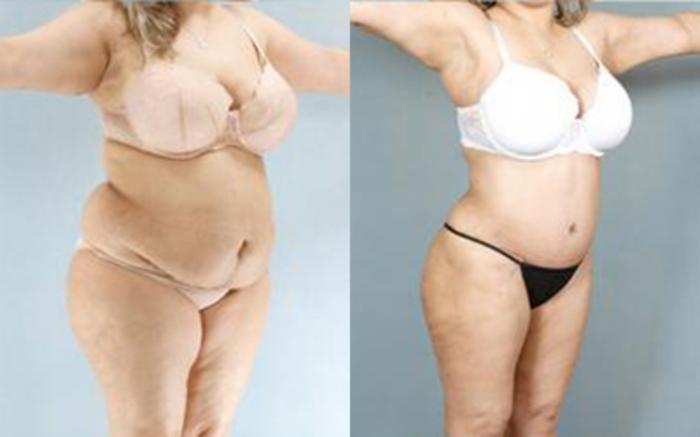Before & After Tummy Tuck Case 61 View 2 View in Houston, TX