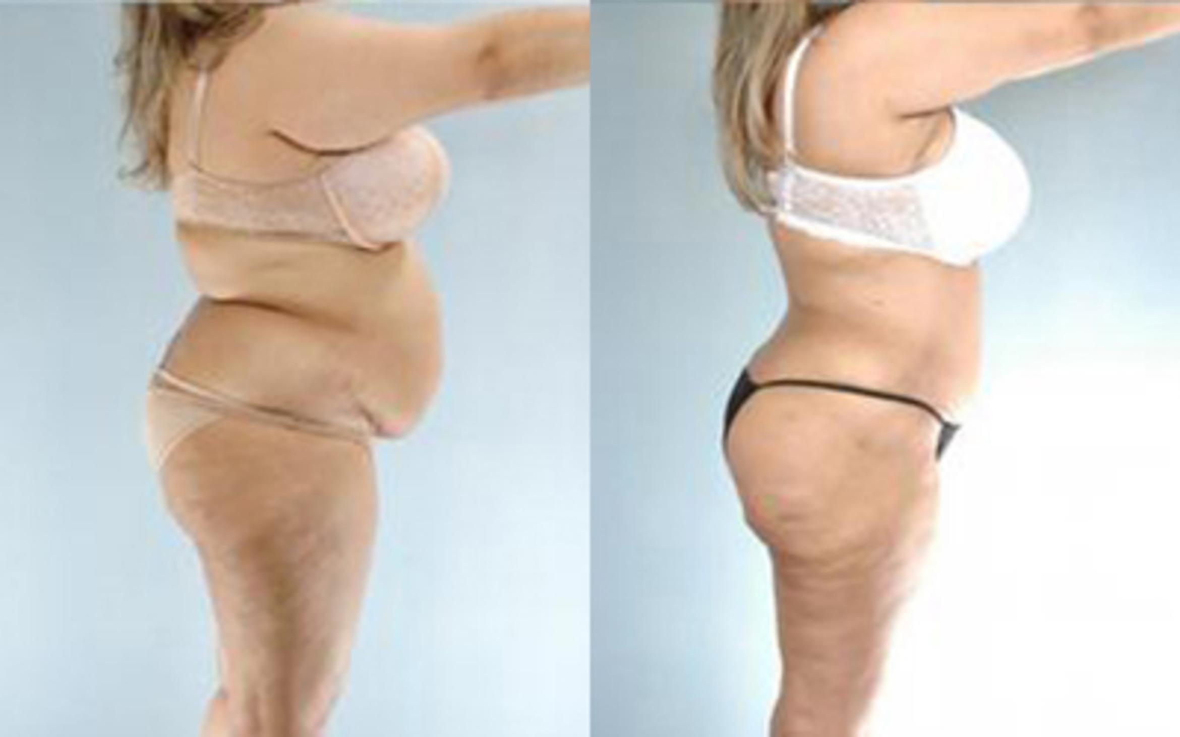 Before & After Tummy Tuck Case 61 View 3 View in Houston, TX